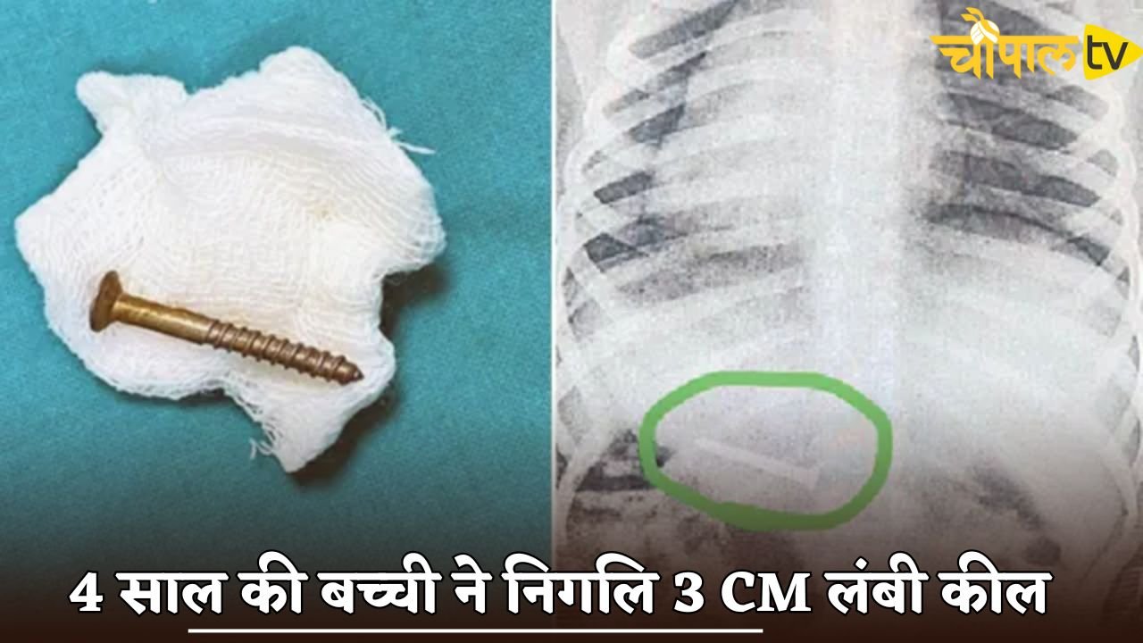 A 4-year-old girl swallowed a 3 cm long nail.